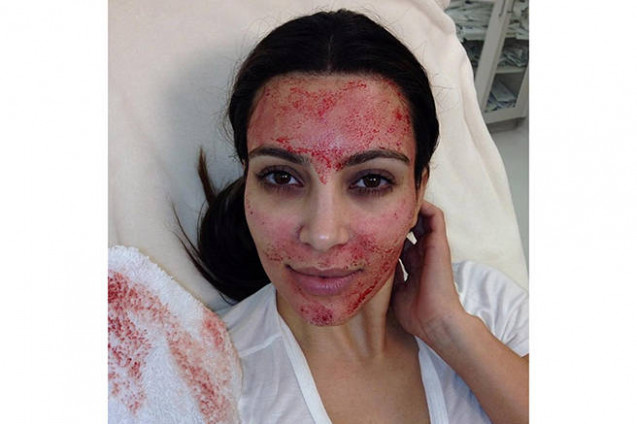 Vampire facial