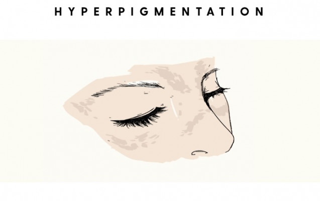 Hyperpigmentation