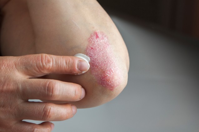 Psoriaris