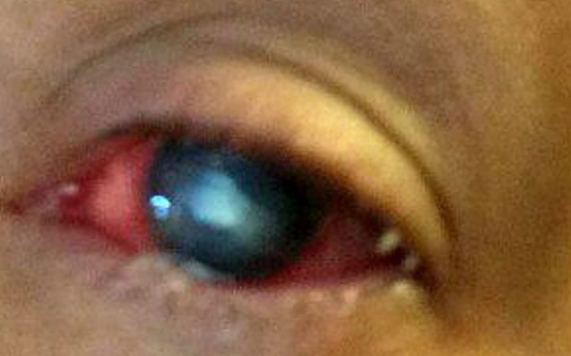 Nearly Blind